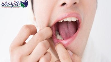 أسباب وأعراض وعلاج قرحة الفم والوقاية منها