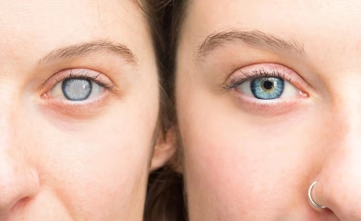 الفرق بين المياه الزرقاء والبيضاء في العين